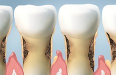 Không đánh răng có tác hại gì? 6 vấn đề sức khỏe từ thói quen nguy hiểm này