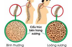 Điểm danh những dấu hiệu thiếu canxi cần phải bổ sung ngay