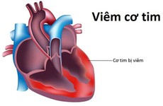 Kết quả điều tra 2 ca tử vong do "virus viêm cơ tim" và phản ứng của các bác sỹ trước tin đồn liên quan