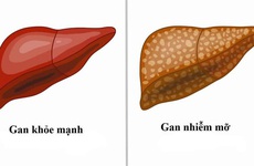 Khi nào nên đi xét nghiệm gan nhiễm mỡ?