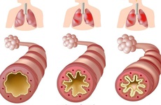 Tìm hiểu về dấu hiệu và cách điều trị hen phế quản độ 2