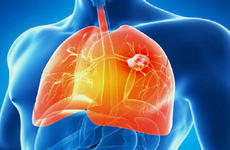Một số phương pháp bảo vệ phổi bạn có thể áp dụng