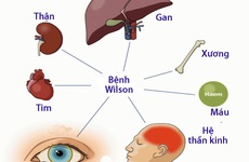 Bệnh lý nguy hiểm khi cơ thể thừa Đồng lâu ngày