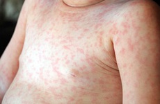 Trẻ bị phát ban sau sốt virus có nguy hiểm không?
