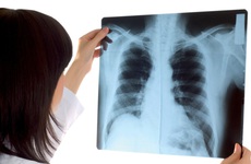 Những điều cần biết về chụp X-quang phổi