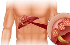 Phân biệt viêm gan mạn tính và xơ gan: cảnh báo nguy hại sức khỏe gan