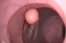 Bệnh polyp đại trực tràng là gì? Những điều cần biết về polyp đại trực tràng