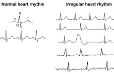 Rối loạn nhịp tim là gì? 10 điều cần nhớ về chứng rối loạn nhịp tim