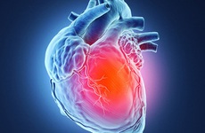 Nhồi máu cơ tim là gì? 10 điều cần nhớ về nhồi máu cơ tim