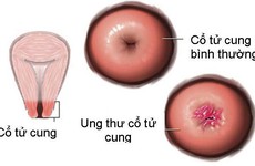 Ung thư cổ tử cung di căn sống được bao lâu?