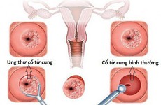 Ung thư cổ tử cung: Nguyên nhân, dấu hiệu và cách phòng tránh