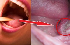 Cách chẩn đoán ung thư vòm họng theo độ nặng và giai đoạn (giải phẫu bệnh lý)