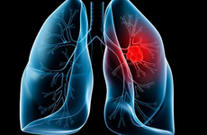 Bị ung thư cổ tử cung di căn phổi: Cơ hội sống sót thực sự không còn?