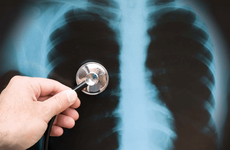 Bệnh viêm phổi có chữa được không?