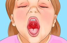 Bệnh viêm họng trắng có nguy hiểm không và cách điều trị an toàn