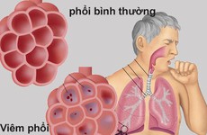 6 biến chứng của viêm phổi cần được chú ý đặc biệt