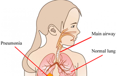 Làm thế nào để điều trị dứt điểm viêm phổi do virus, tránh biến chứng xảy ra?