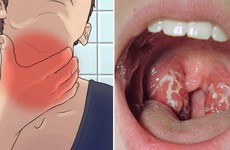 Nổi hạch ở sau hàm có thể là dấu hiệu bệnh viêm họng giả mạc