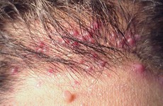 Bệnh viêm nang lông có nguy hiểm không?