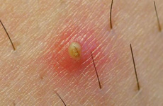 Các dấu hiệu viêm nang lông thường gặp ở lưng và tay, chân