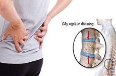 Cảnh giác với một số biến chứng của bệnh loãng xương: Có thể bị tàn phế suốt đời!