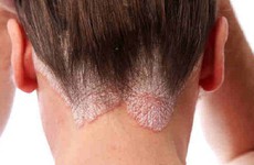Những dấu hiệu nhận biết viêm nang lông ở da đầu