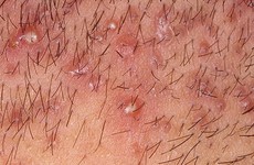 Những dấu hiệu nhận biết viêm nang lông vùng kín