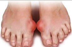 Các nguyên tắc chăm sóc bệnh nhân bị bệnh gout cần được chú ý đặc biệt