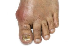 Tổng hợp các dấu hiệu của bệnh gout không được bỏ qua
