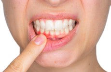 Sức khỏe răng miệng suy giảm có thể là dấu hiệu loãng xương ở người trẻ