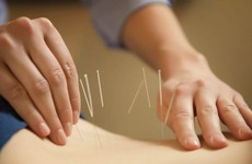 Tác dụng của phương pháp châm cứu trong chữa trị đau lưng