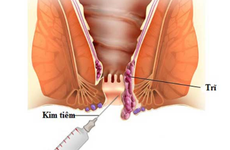 Thủ thuật chích xơ chữa bệnh trĩ