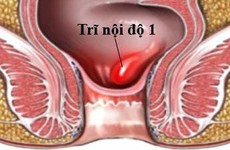 Điều trị sớm trĩ nội độ 1