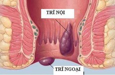 Hướng dẫn cách phân biệt trĩ nội và trĩ ngoại