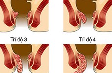 Nhận biết các triệu chứng của bệnh trĩ theo cấp độ