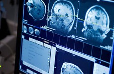 Một số dấu hiệu ung thư thanh quản di căn não