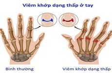 Các phương pháp chẩn đoán bệnh viêm khớp dạng thấp