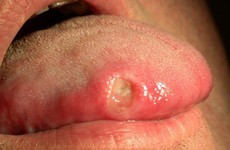 Ai nên tầm soát ung thư lưỡi sớm và thường xuyên?