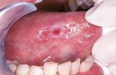 Virus HPV - nguyên nhân gây ra bệnh ung thư lưỡi bạn nên thận trọng