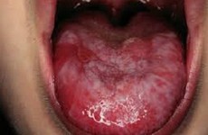 8 ảnh hưởng xấu đến cơ thể sau điều trị ung thư lưỡi