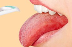 Đau rát lưỡi là bệnh gì? Có phải dấu hiệu cảnh báo bệnh lý nguy hiểm?