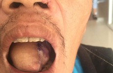 Tái tạo lưỡi ung thư lưỡi có thể gặp biến chứng gì?