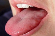 Những điều cần lưu ý khi tái tạo lưỡi do ung thư lưỡi