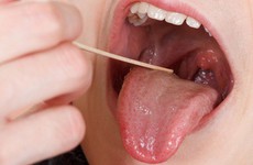 Khi nào chỉ định tái tạo lưỡi cho bệnh nhân ung thư lưỡi?
