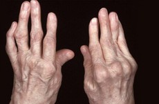 Thuốc điều trị viêm khớp dạng thấp có những loại nào?