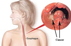 Tìm hiểu chung về các phương pháp điều trị ung thư thực quản