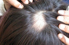 Rụng tóc, hói đầu là gì? 10 điều bạn nên biết về chứng bệnh "mất thẩm mỹ" này!