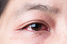 Tổng quan về bệnh đau mắt đỏ là gì? Nguyên nhân, dấu hiệu và cách điều trị