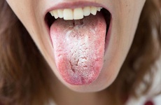 Bệnh nấm lưỡi là gì? Dấu hiệu nhận biết và cách điều trị bệnh nấm lưỡi