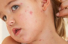 Bệnh Rubella là bệnh gì? Nguyên nhân, dấu hiệu và cách phòng tránh